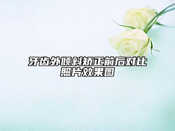 牙齒外傾斜矯正前后對(duì)比照片效果圖
