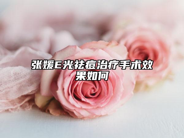 張媛E光祛痘治療手術(shù)效果如何